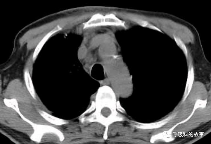 我是如何诊治肺炎的？（4）——如何理解抓住关键信息（2）