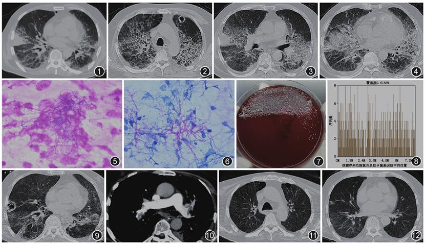 豚鼠耳炎奴卡菌,豚鼠耳炎奴卡菌感染