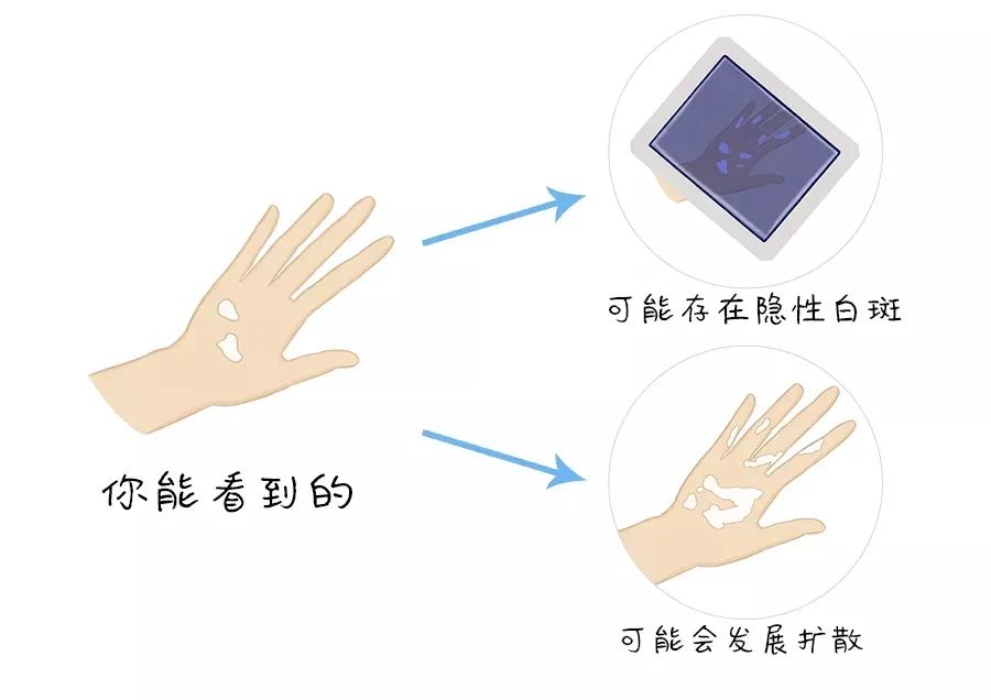 河南白癜风医院,河南白癜风免费治疗政策下发