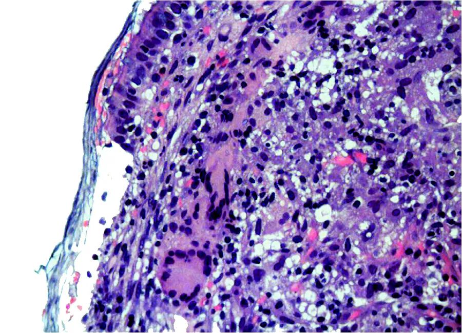 粟粒状肺结核肺部ct表现,粟粒型肺结核ct图