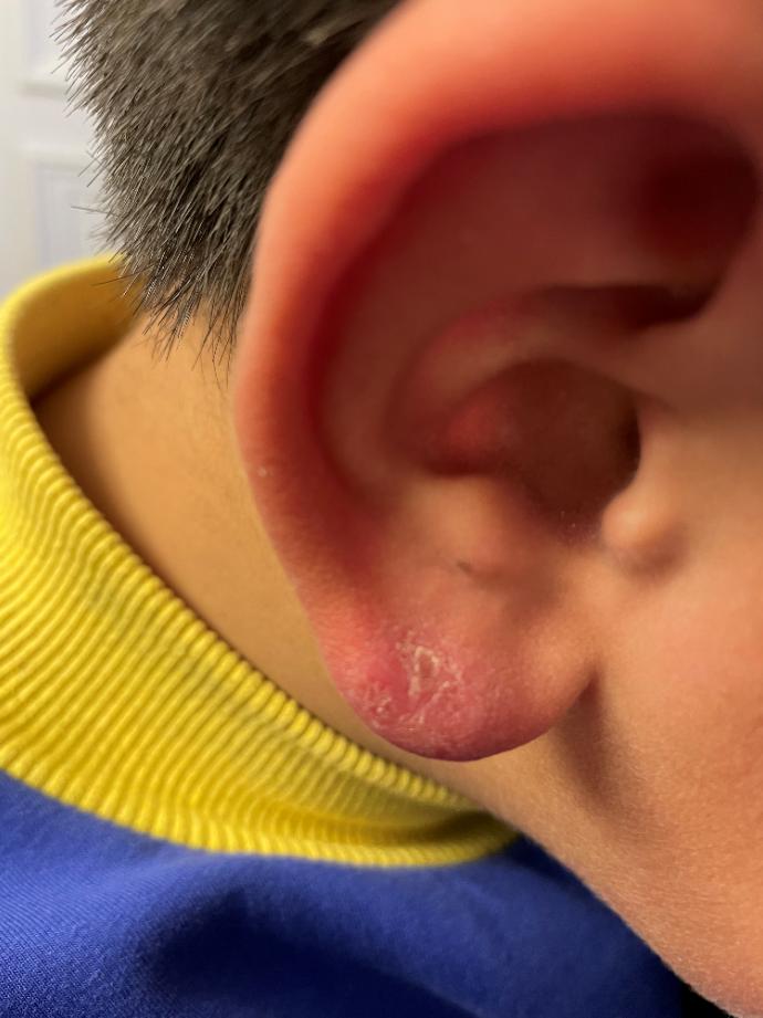 中医手指冻疮的快速消除方法,预防冻疮中药泡手配方