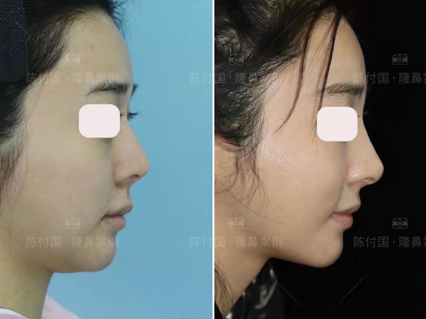 隆鼻鼻尖显形露鼻孔怎么修复,隆鼻修复微驼峰