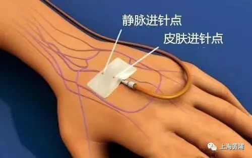 手上输液后黑青怎么办,手上输液有青块怎么快速消除