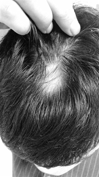 斑秃严重的人怎么治疗,斑秃的人怎么办啊