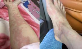 又痒又痛的红色疹子,又长湿疹又长荨麻疹怎么办