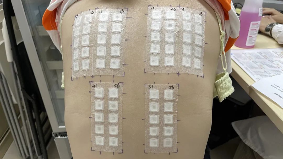 对紫外线过敏是皮肤发红吗,对紫外线过敏是不是过敏性皮炎