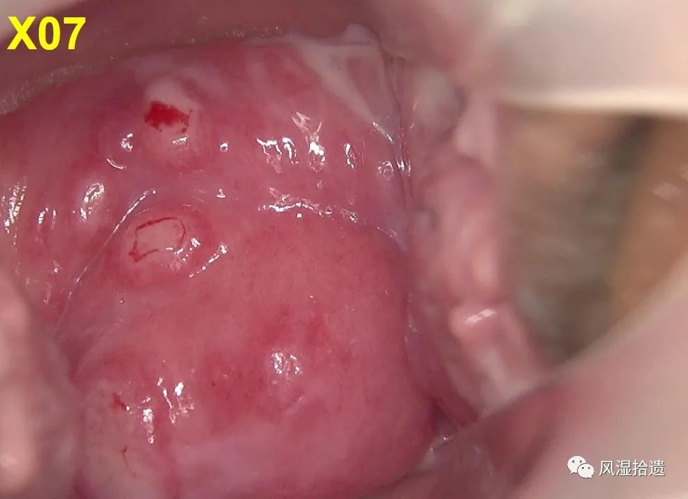 「病例分享」阴道镜和胃镜检查后发现的白塞病