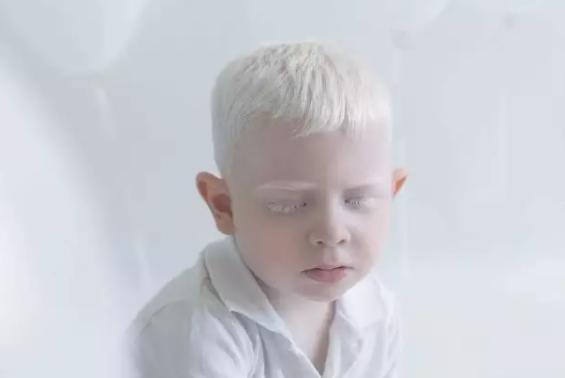 很年轻却有白头发怎么办,39岁毛发变白越来越多是什么原因