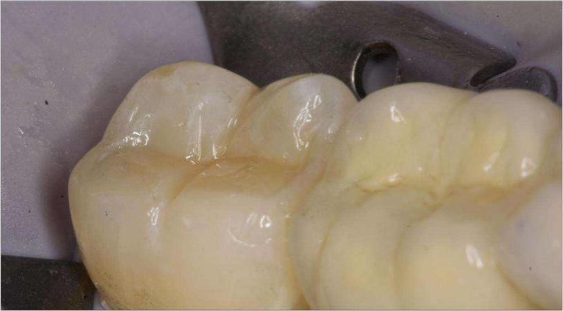 补牙是怎么补的揭秘补牙全过程,补牙是不是越补牙洞越大