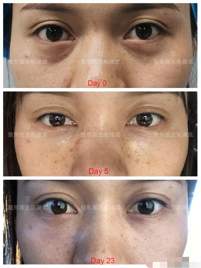 去眼袋泪沟医美方法,想了解一下去眼袋的最佳方法