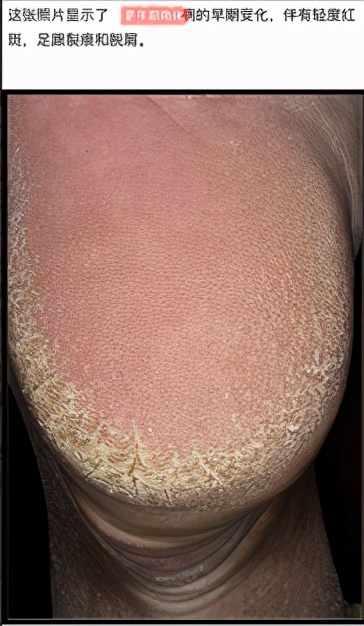 老年人脚底皮肤皲裂症原因是什么,更年期脚后跟皲裂是怎么回事