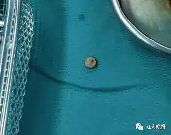 2岁女童误吞纽扣电池有什么反应,7岁小孩误吞纽扣电池