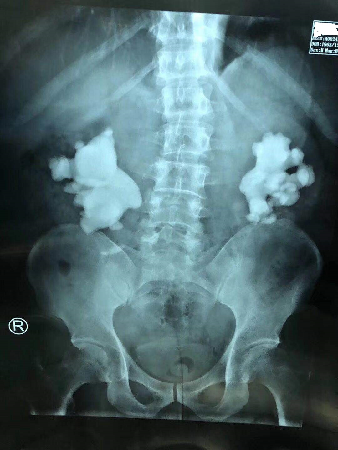 疯狂的石头碎石,疯狂的石头包世宏结石