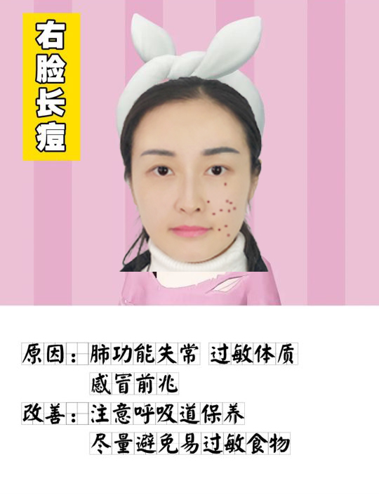 脸上各个位置长痘痘的原因是什么,脸上痘痘的种类及图片