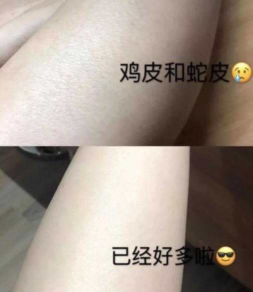 身体干燥起皮用哪种凡士林身体乳,冬天皮肤干可以涂甘油加面霜吗