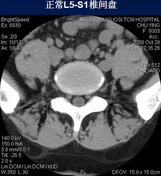 腰椎管狭窄的磁共振诊断标准,腰椎轻度退行性变化椎间盘膨出