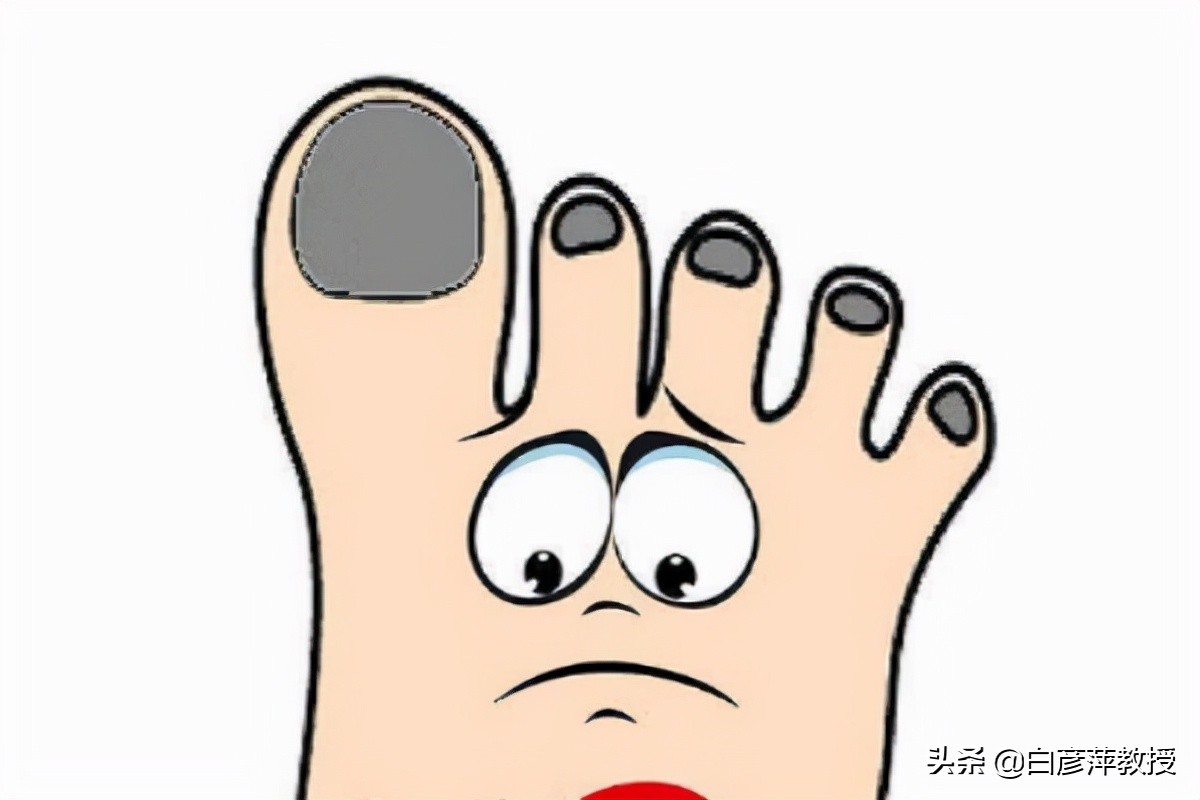 灰指甲是真菌怕晒吗,灰指甲一定是灰色的吗