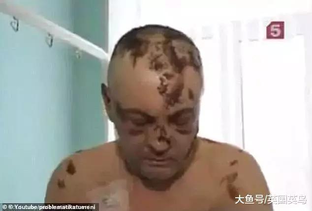 *洛因海**的廉价替代品，“鳄鱼”泛滥，吸食者皮肤溃烂如鳄鱼鳞片