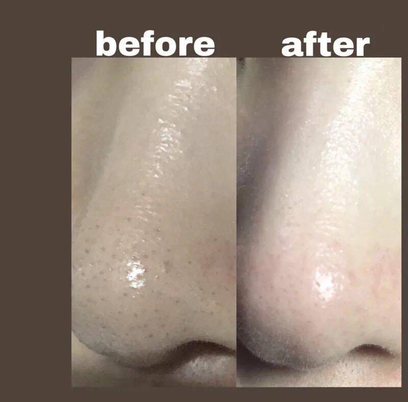 去黑头粉刺的最有效最简单的方法,你不能不知道的去粉刺秘籍