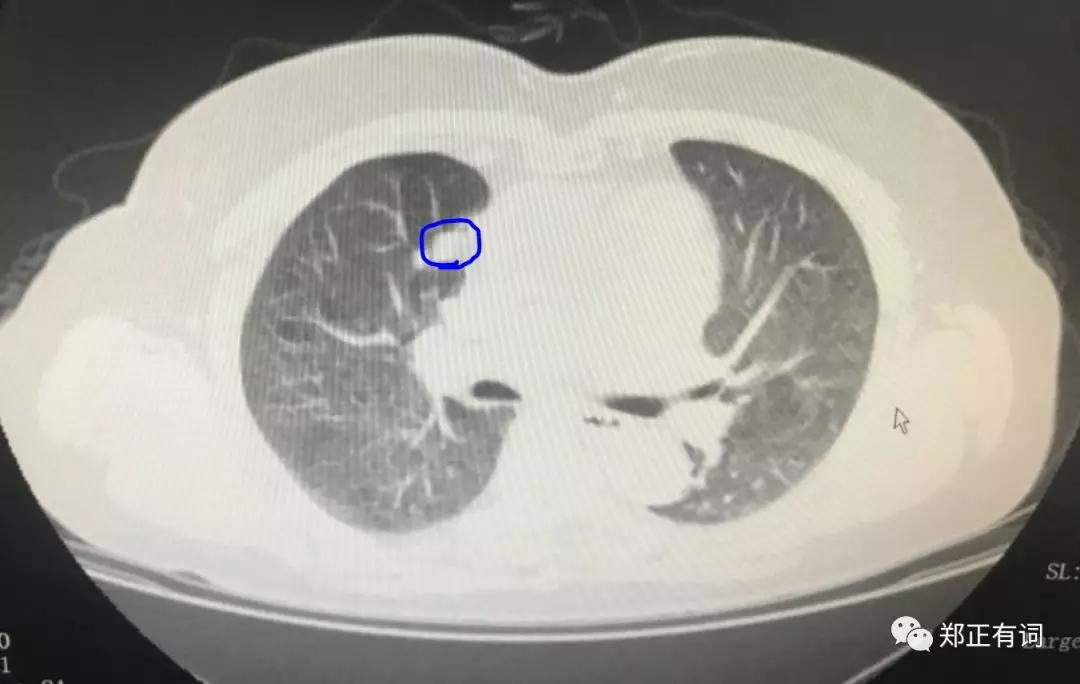 心肺功能特差的肺癌病人,肺癌病人怎么提高心肺功能