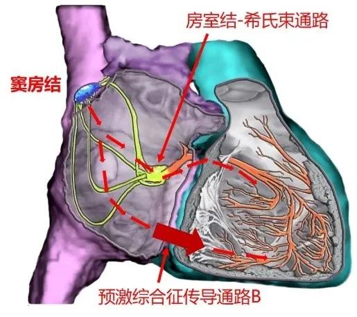 得了预激综合征严重吗,为什么会得预激综合征