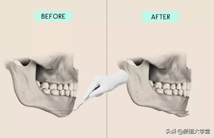 下巴后缩怎么拍侧颜,下巴后缩需要怎么矫正