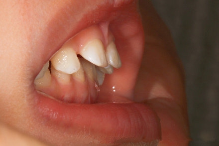 发现孩子牙齿畸形怎么办,儿童怎么预防牙齿畸形不整齐