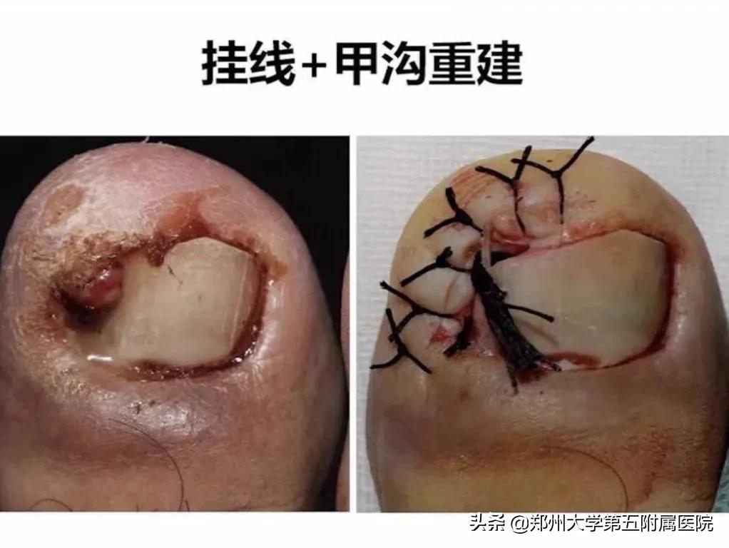 小孩怎么预防嵌甲,怎么预防嵌甲和甲沟炎