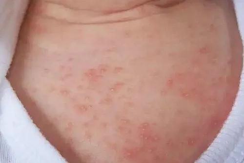 夏季宝宝湿疹高发，爸妈学会这几招，轻松应对宝宝湿疹