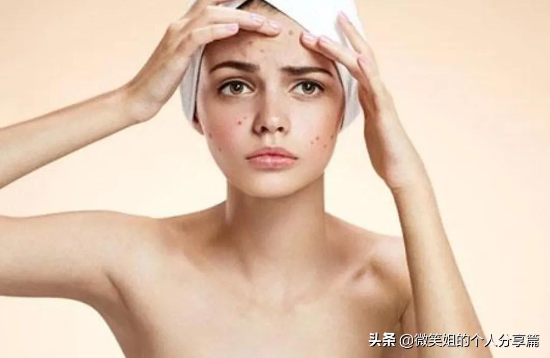 人中反复长痘,长闭口是怎么回事?