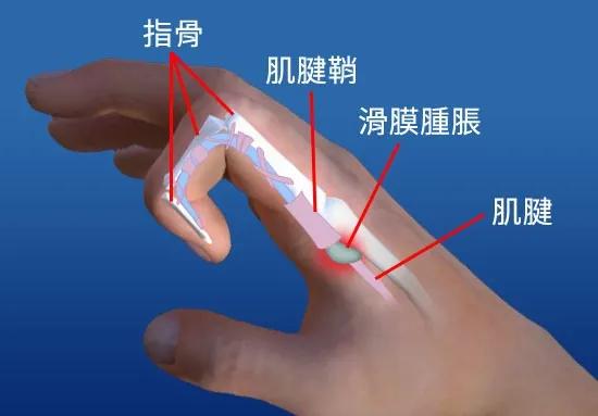 狭窄性腱鞘炎的诊断及治疗。