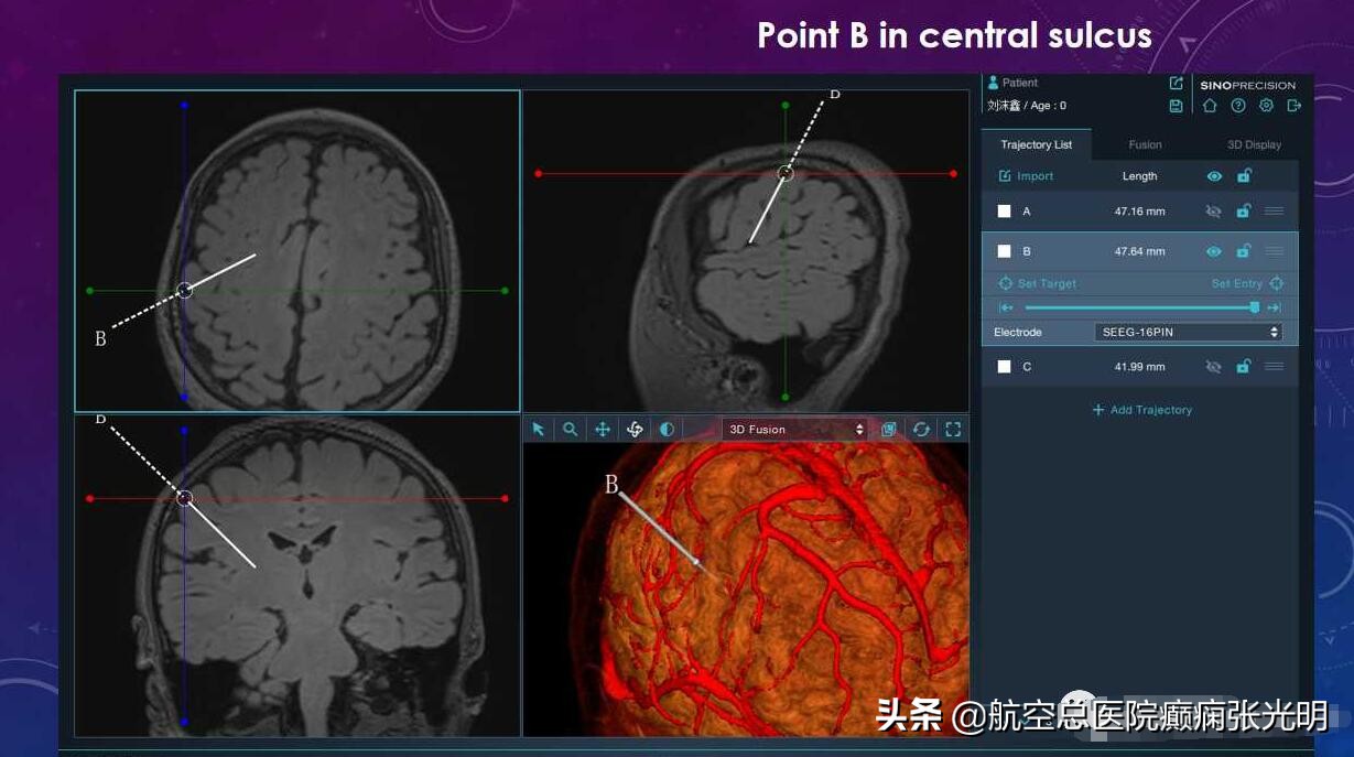 张光明左颞叶癫痫手术成功率,张光明谈治疗癫痫的方法有哪些