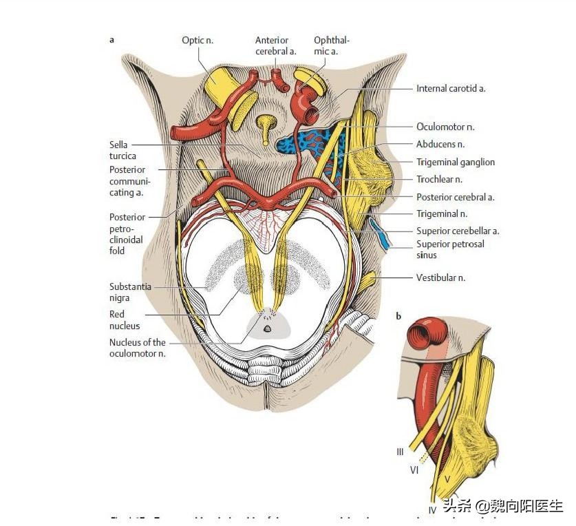 颈动脉海绵窦瘘症状,颈动脉海绵窦瘘介入需要多少钱