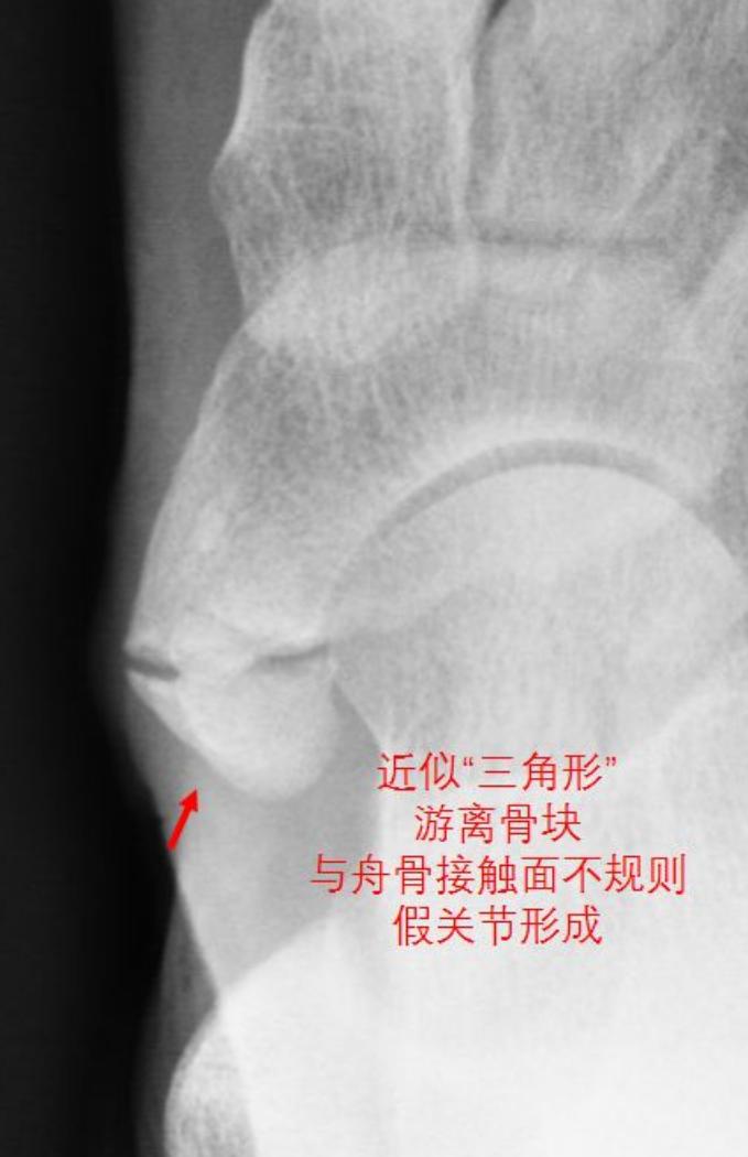 成人足副舟骨痛最佳解决方案,后天性扁平足导致副舟骨疼痛