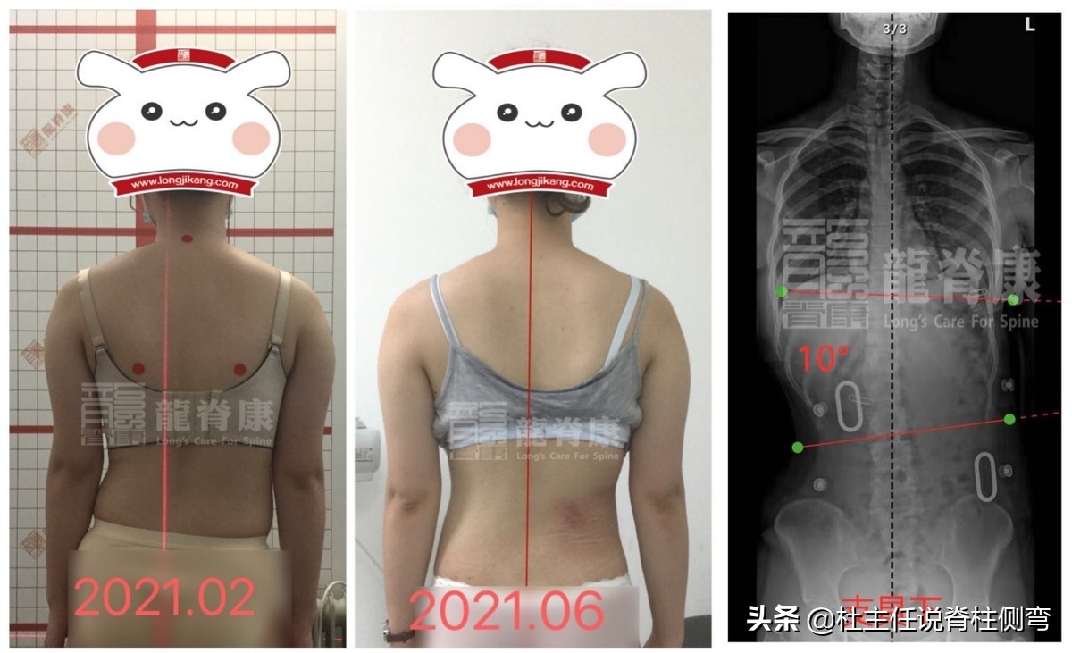 成年人轻微脊柱侧弯能恢复吗,脊柱侧弯成年人度数还长吗