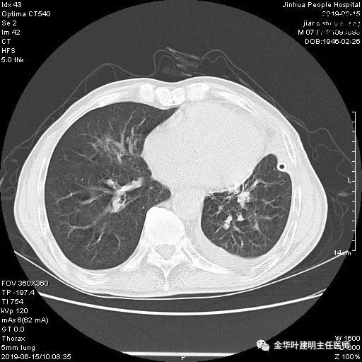 肺手术后乳糜胸是医疗事故吗,肺部切除后乳糜胸治好了