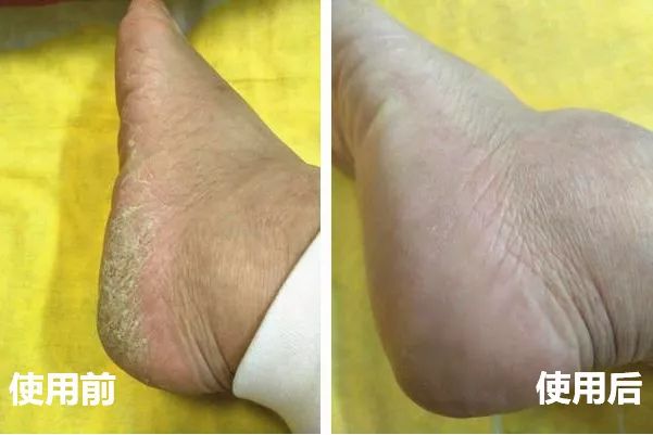 手脚皮肤干裂怎样快速保湿,缓解手脚干裂的小妙招