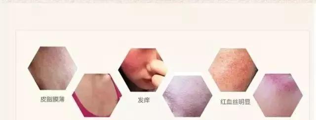 春敏后期全脸脱皮,过敏脸上起皮发痒