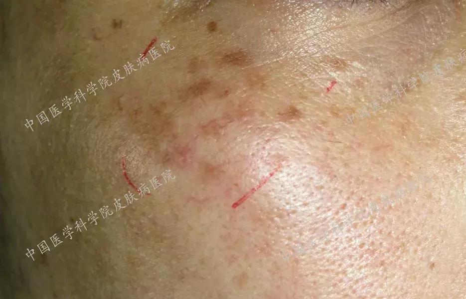 什么护肤品对晒斑有效,角质层薄有晒斑用什么护肤品