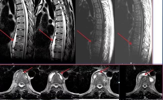 脊柱结核保守治疗大约需要多少钱,脊柱结核可以保守治疗