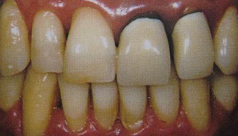 牙齿小知识烤瓷牙,牙医牙齿美白要做吗