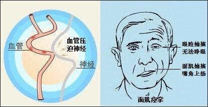 面肌痉挛手术后3年眼皮跳,长时间下眼皮抽搐痉挛怎么治