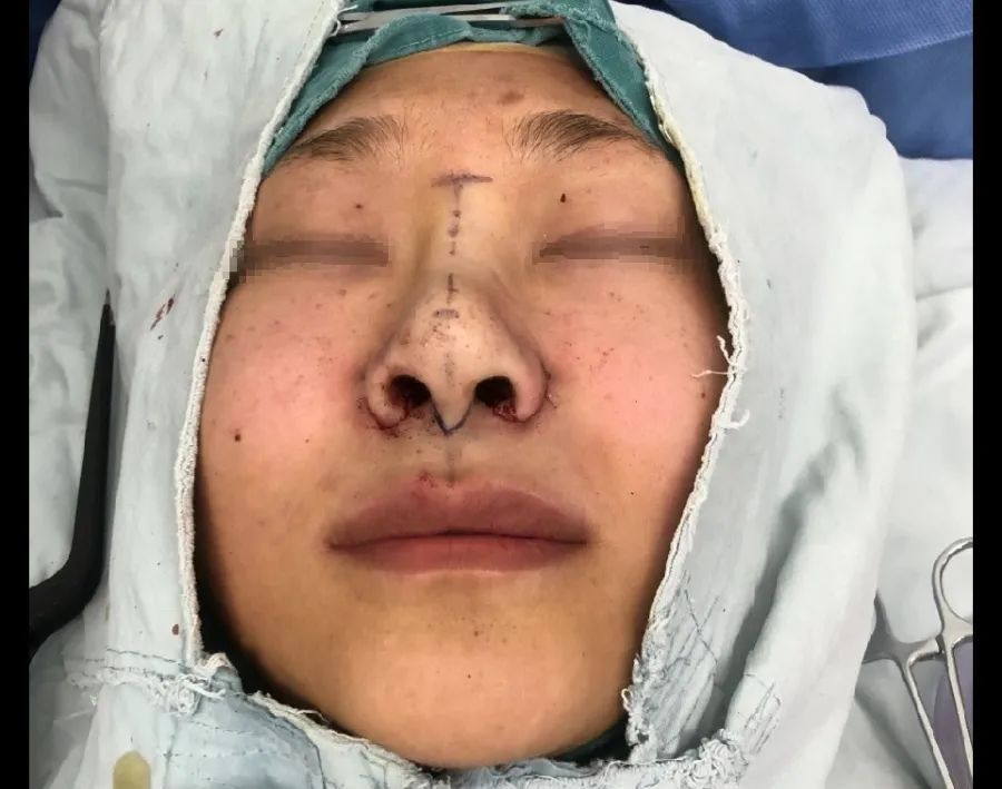 鼻翼缩小内缩和外缩的区别,鼻头缩小和鼻翼缩小是一个手术吗