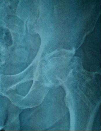 儿童股骨头坏死是怎么引起的,长期吃激素药怎样预防股骨头坏死