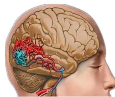 脑血管先天性畸形怎样治疗,老年人脑血管畸形的治疗方法