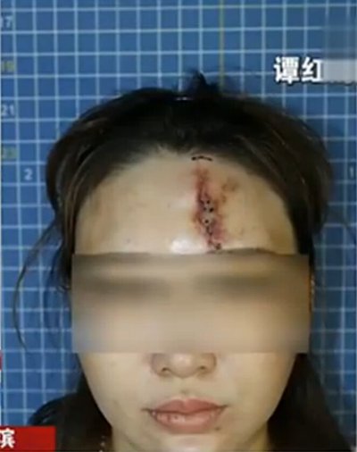 为什么医生不建议你选玻尿酸除皱,为什么微整形不敢做