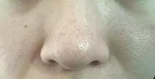 毛孔堵塞油腻粗大如何改善,毛孔粗大改善方法控油遮瑕