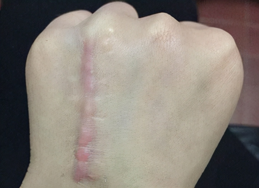 刀口增生会自动恢复吗,剖腹产刀口增生了怎么消除