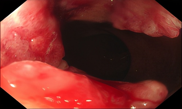 低位直肠癌保肛手术不造瘘利弊,低位直肠癌保肛会影响复发率么