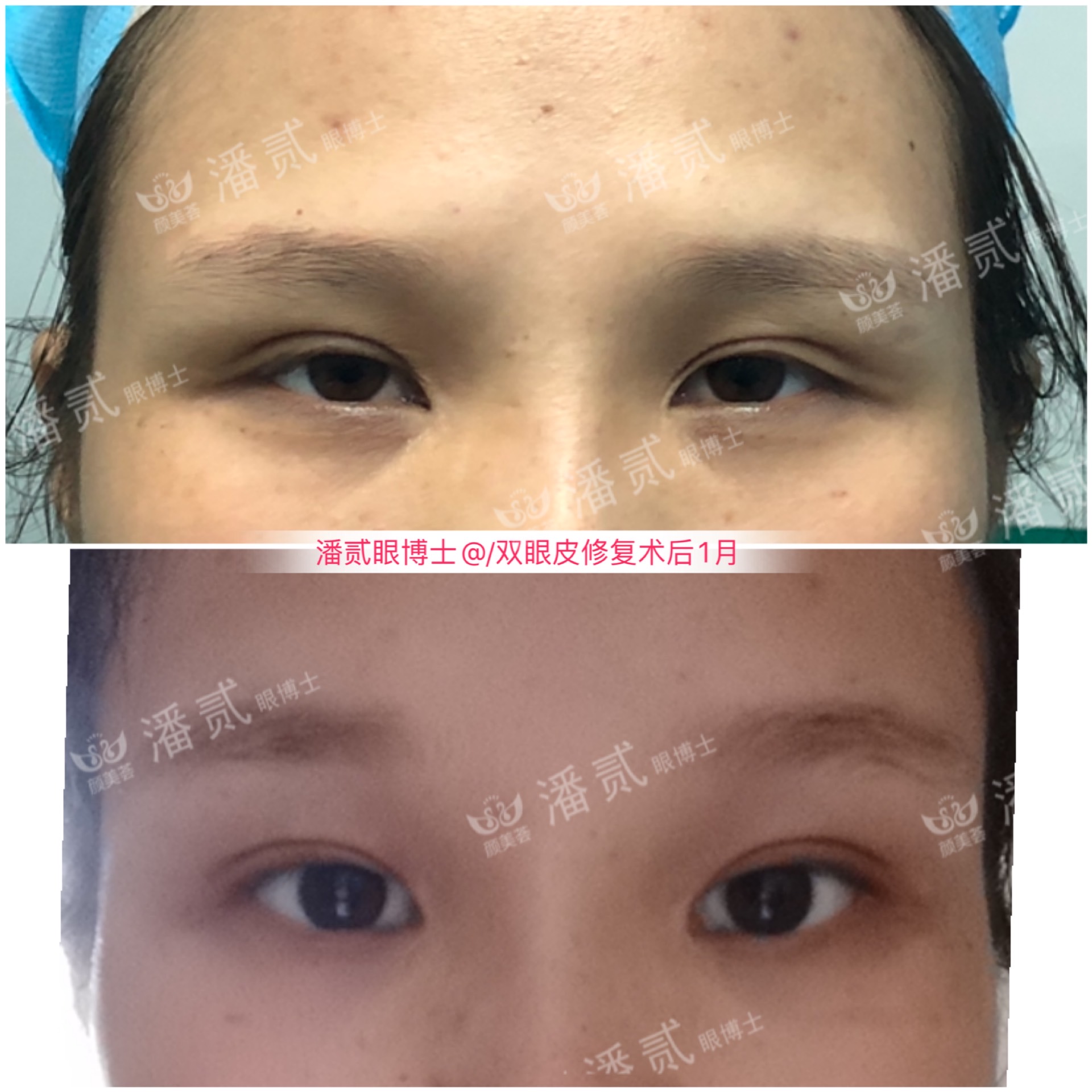 割双眼皮和眉骨有关系吗,做双眼皮想要圆眼割什么样的